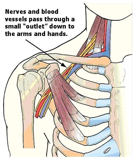 Figure 4 from Thoracic outlet syndrome.